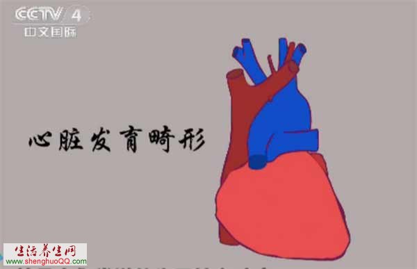 心脏发育畸形