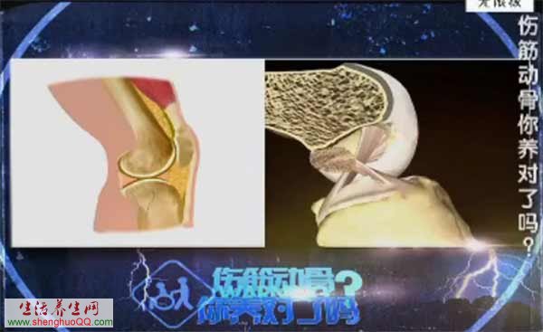 骨折之后需不需要静养