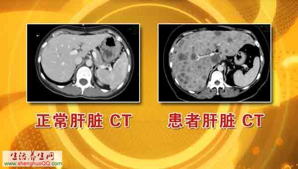 正常肝脏与肝癌的CT对比图