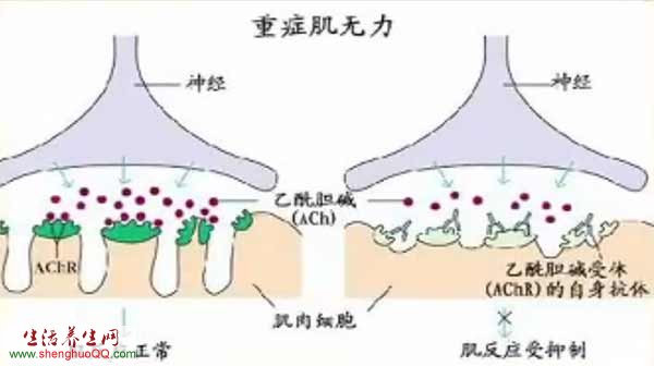 重症肌无力原理