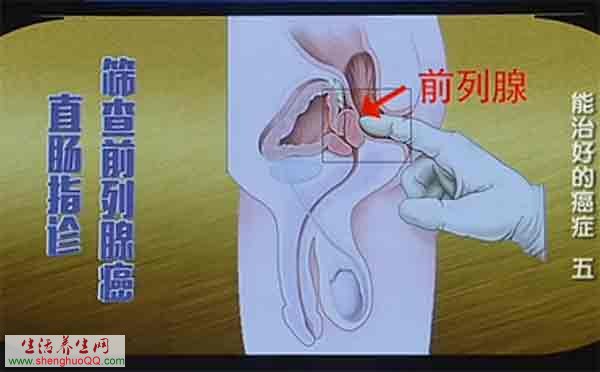 直肠指诊筛查前列腺癌