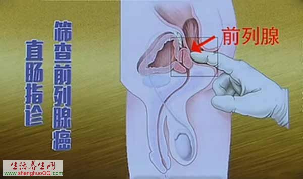 直肠指诊筛查前列腺癌