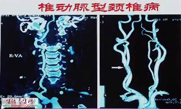 椎动脉型颈椎病