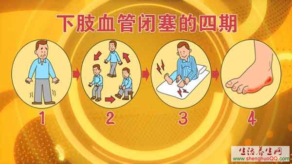 下肢动脉硬化闭塞治疗