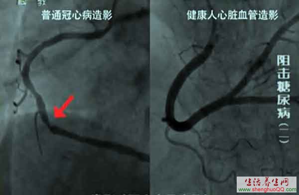 健康人与冠心病患者的血管造影对比