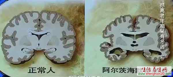 阿尔茨海默症的脑组织