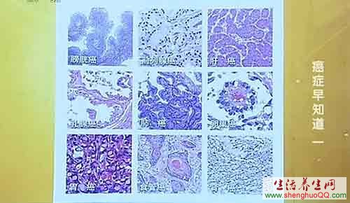 癌细胞的显微结构