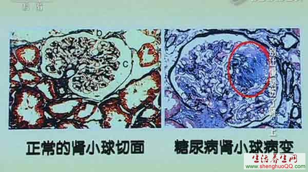 正常肾小球与糖尿病肾小球的区别