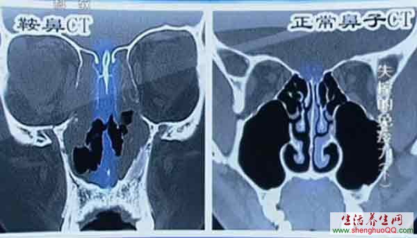 鼻梁塌与免疫力紊乱