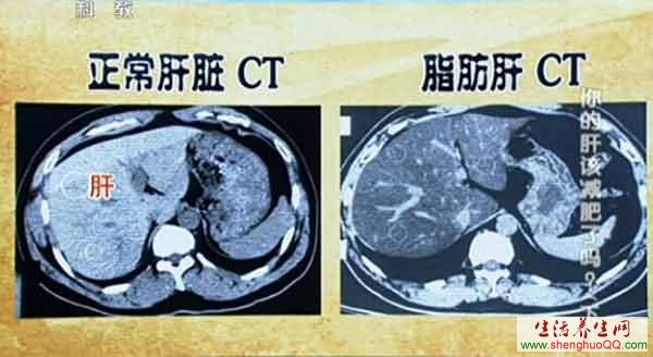 CT检查脂肪肝