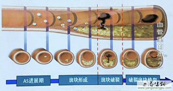 血管斑块的形成过程