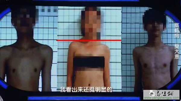 脊柱侧弯