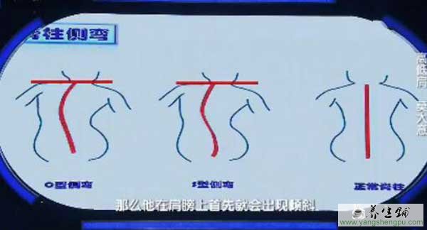 脊柱侧弯的类型