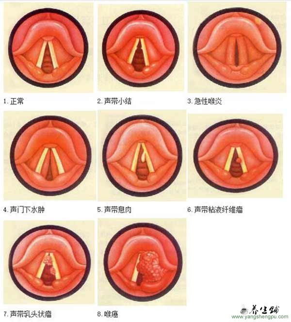 声带-喉疾病