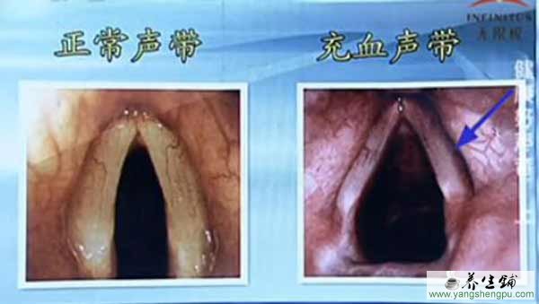声带急性充血
