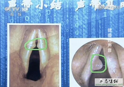 声带小结、声带息肉