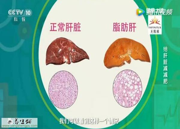  正常肝与脂肪肝的区别