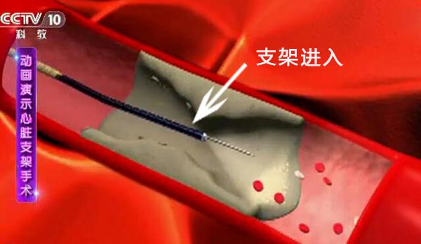 支架进入狭窄区域