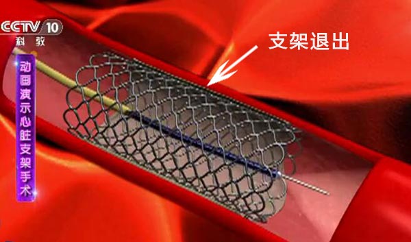 支架退出血管
