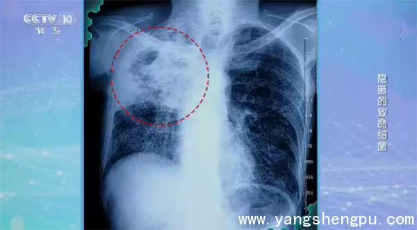 结核菌感染的肺