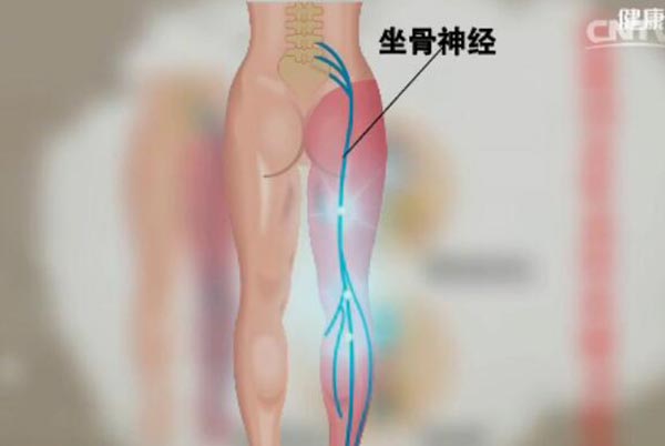 腰椎间盘突出引起腿疼腿麻的原因