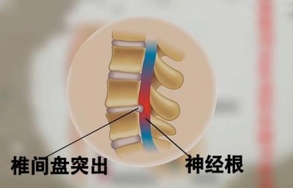 腰椎间盘突出压迫神经根