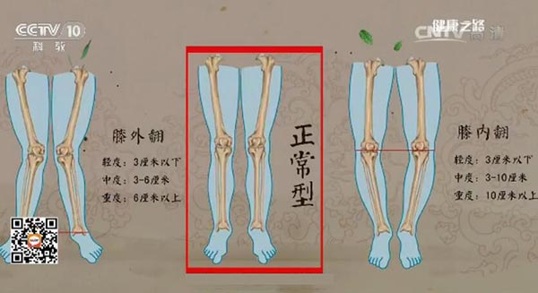 O型腿与X型腿的判断