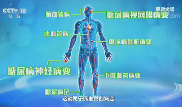 糖尿病早期的并发症