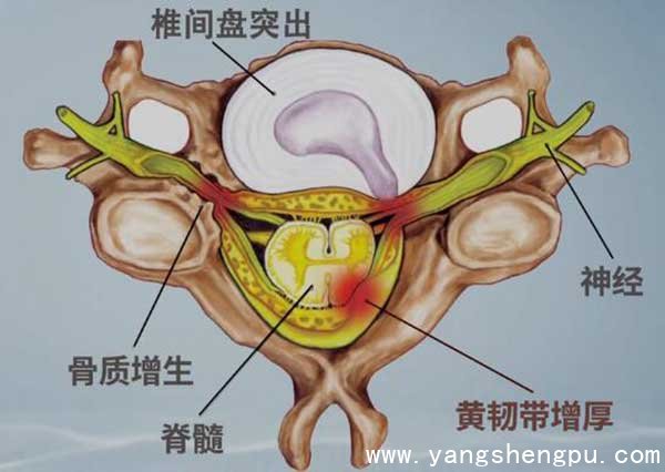 腰椎椎管狭窄