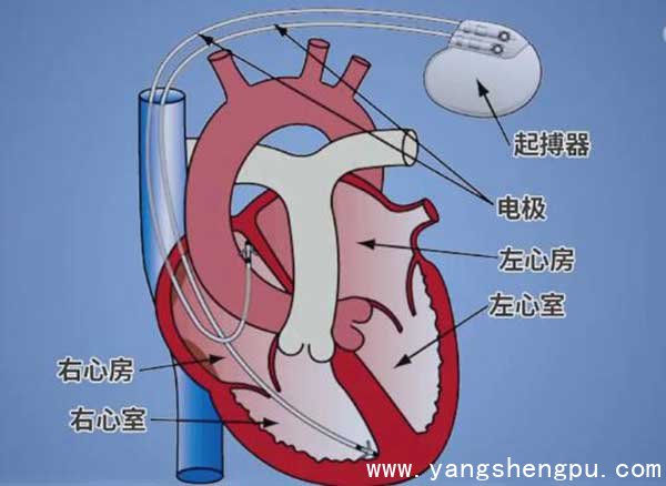 心脏起搏器原因图