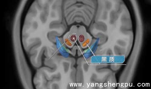 帕金森病的发病原理