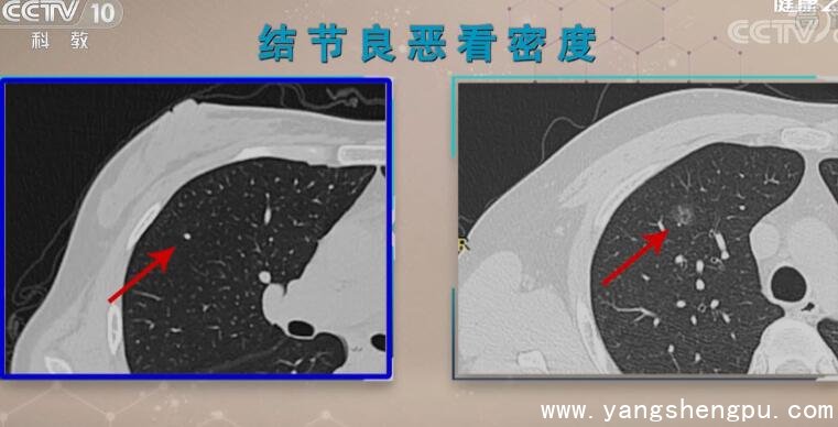 结节良恶看密度