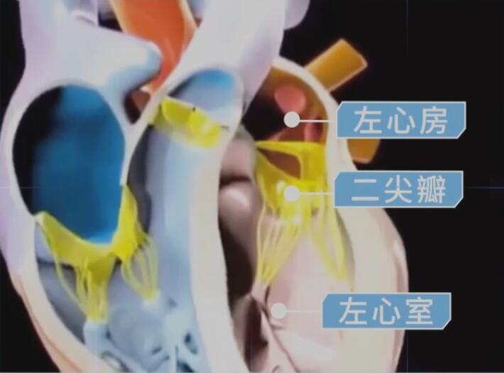 二尖瓣腱索位置图片图片