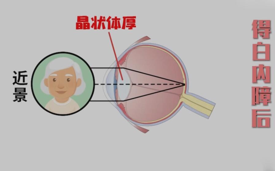 得了白内障后晶状体的改变