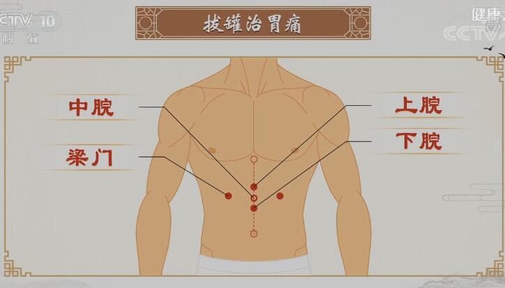 拔罐治疗胃痛