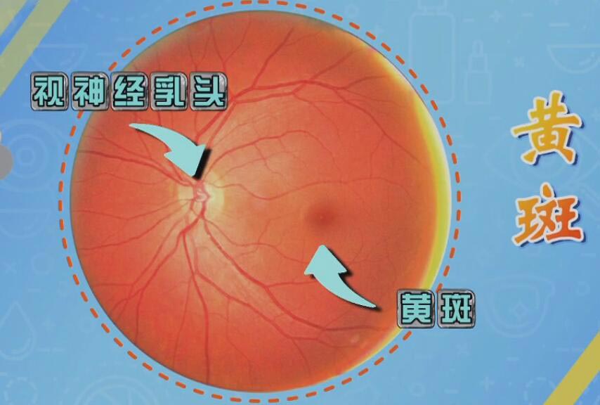 什么是眼内的黄斑