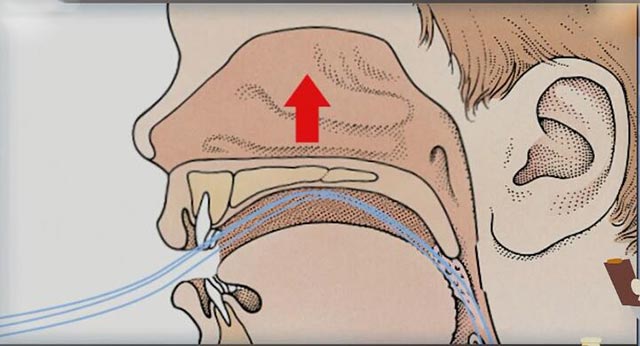 鼻炎后用嘴呼吸导致上腭高拱变形
