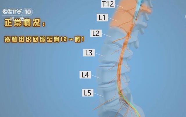 脊髓组织回缩至胸12~腰1的位置