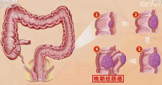 肠癌的发展过程