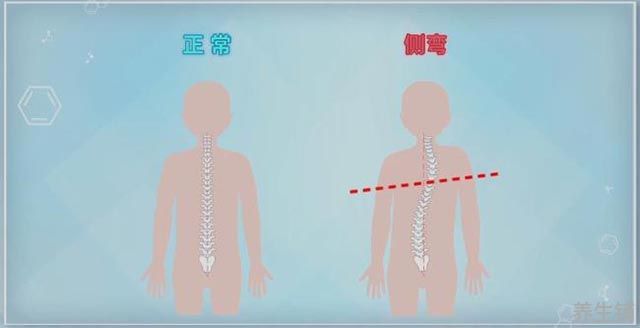脊柱侧弯