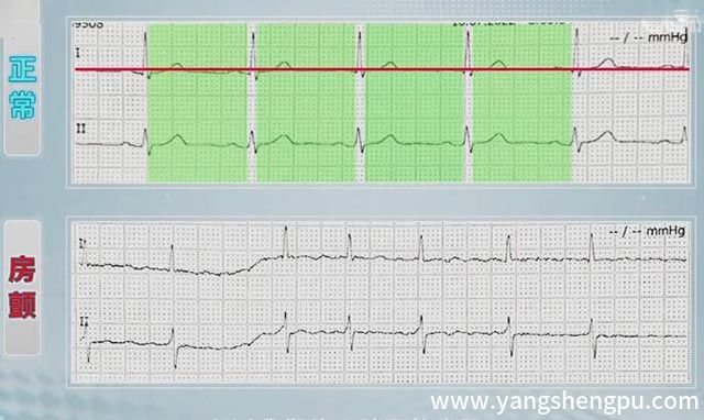 房颤心电图与正常心电图对比