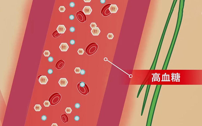 糖尿病足是如何引发的