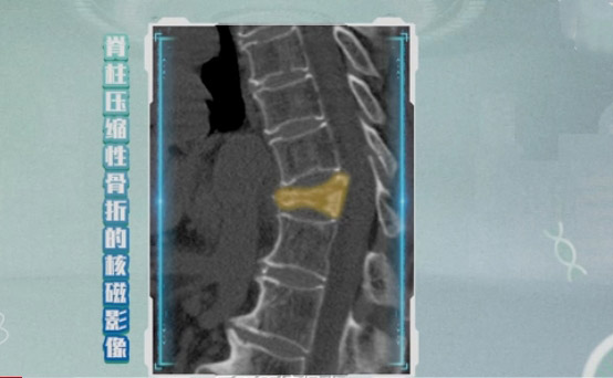 脊柱发生压缩性骨折