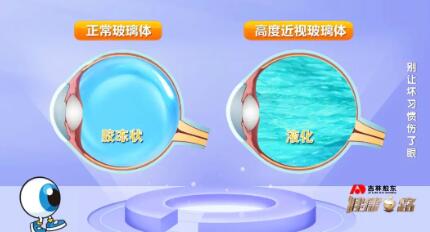 正常玻璃体VS高度近视玻璃体