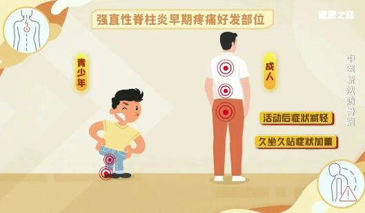 强直性脊柱炎早期痛疼好发部位