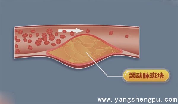 颈动脉斑块