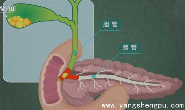 胆结石堵塞在胆管与胰管的交界处