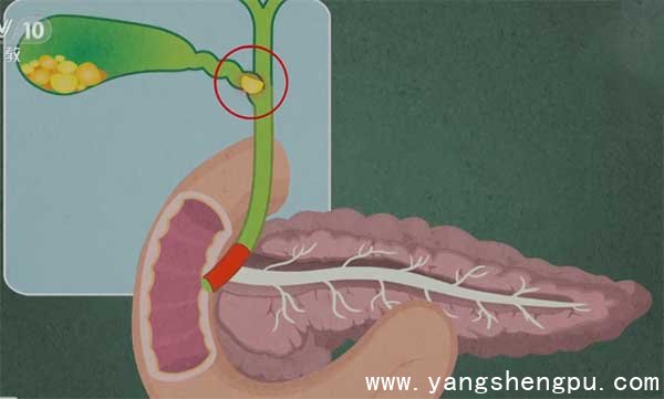 胆结石卡在胆囊出口