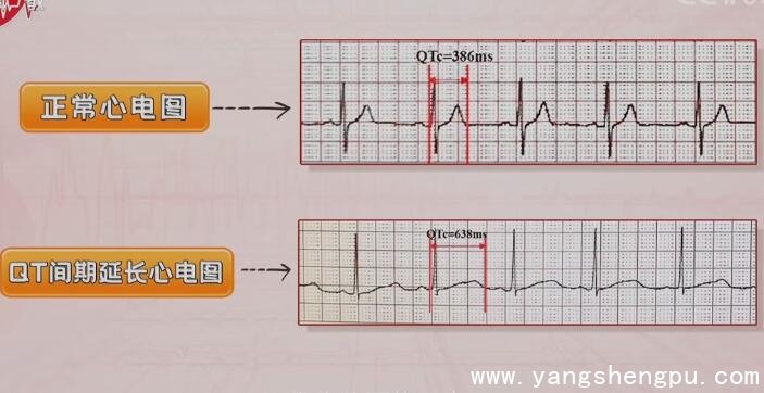 正常心电图与QT间期延长心电图