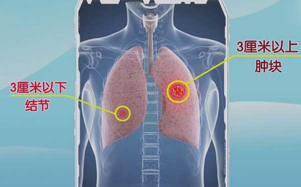 肺上的结节与肿块